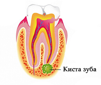 Видалення кісти зуба