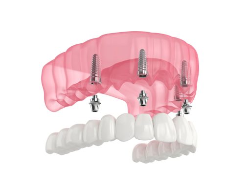 Імплантація зубів All-on-4