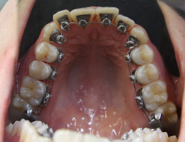 На цьому етапі лікар зафіксував брекети до порожнини рота пацієнта, надав рекомендації по догляду за зубами під час ортолікування, та записав на корекцію через місяць.