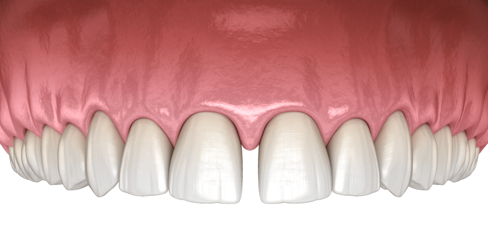Діастема зубів: причина виникнення та методи лікування щілин між зубами