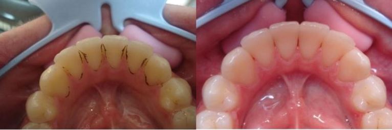 Ультразвукова чистка зубів: що це таке та як проводиться процедура