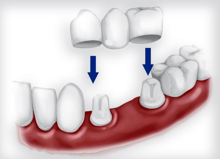 Мостовидний протез: різновиди, переваги та недоліки зубних мостів