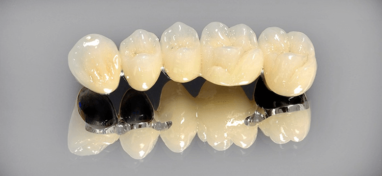 Мостовидний протез: різновиди, переваги та недоліки зубних мостів