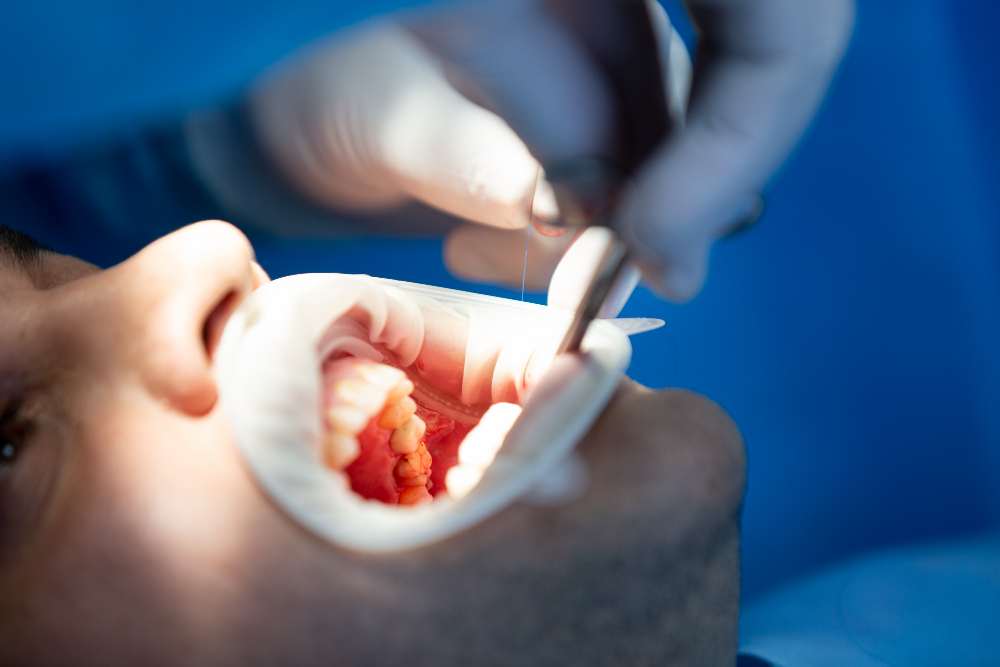 Видалення ретинованого зуба: причини, різновиди та показання до екстракції