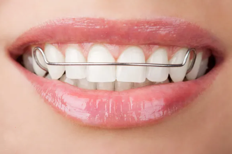 Пластини на зуби