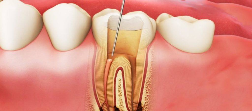 Видалення нерва зуба: коли та як проводиться процедура