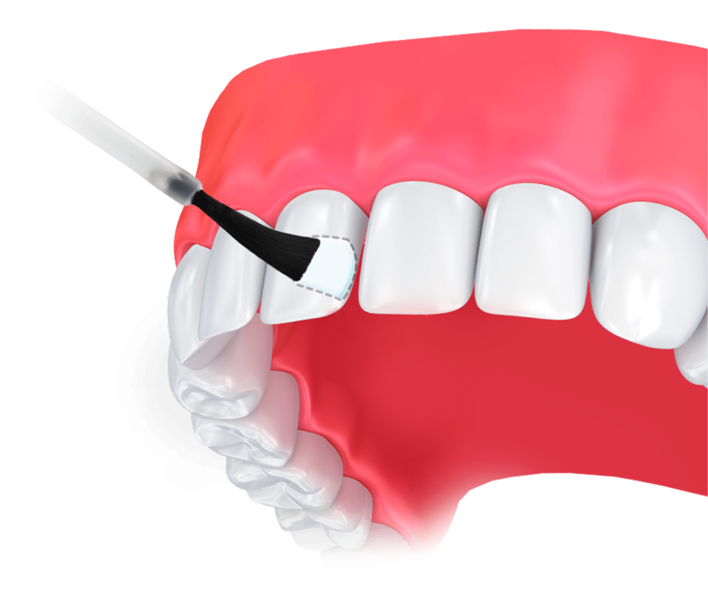 Фторування зубів: коли потрібно робити, способи й етапи фторування
