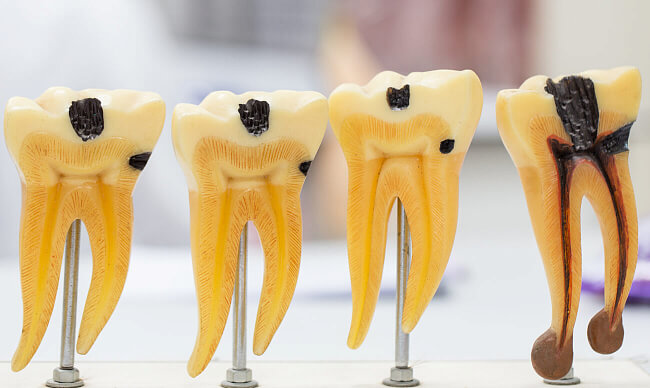 Пульпіт зуба: симптоми, причини та лікування