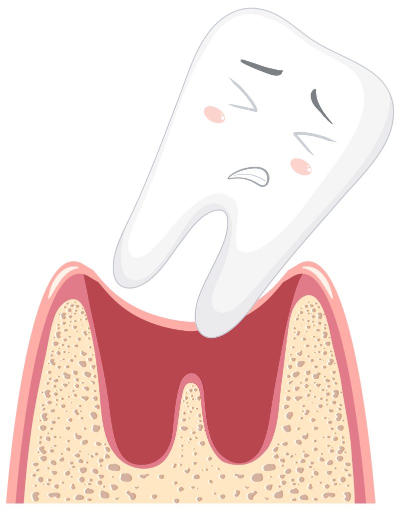 Альвеоліт: причини, симптоми та лікування альвеоліту лунки зуба