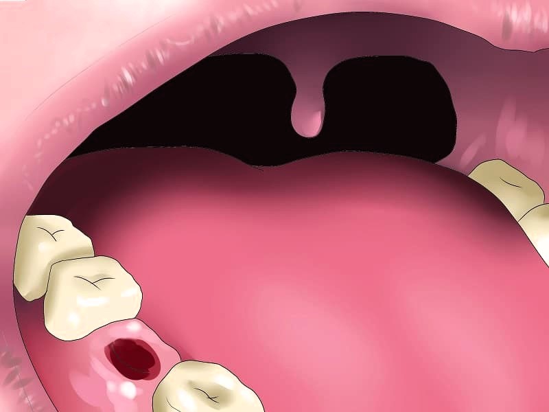 Альвеоліт: причини, симптоми та лікування альвеоліту лунки зуба