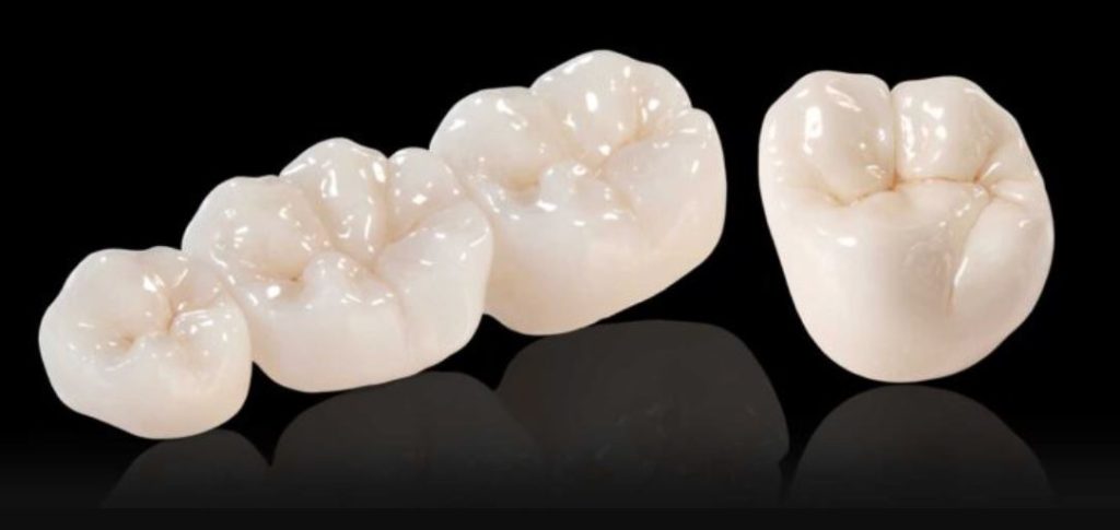 Коронки на зуби: які краще ставити на жувальні і передні зуби