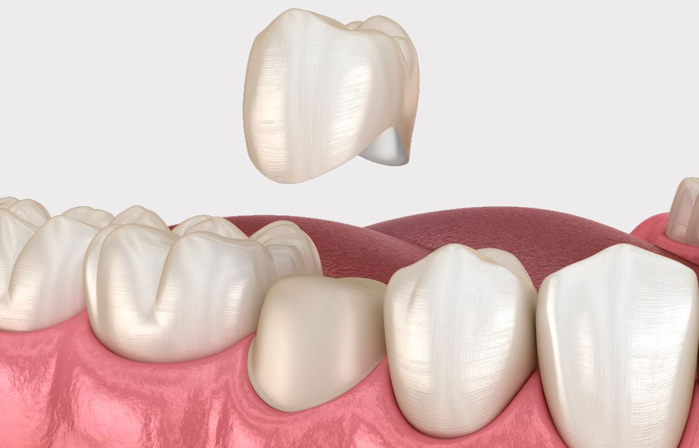 Незнімні зубні протези: види, переваги та недоліки незнімного протезування