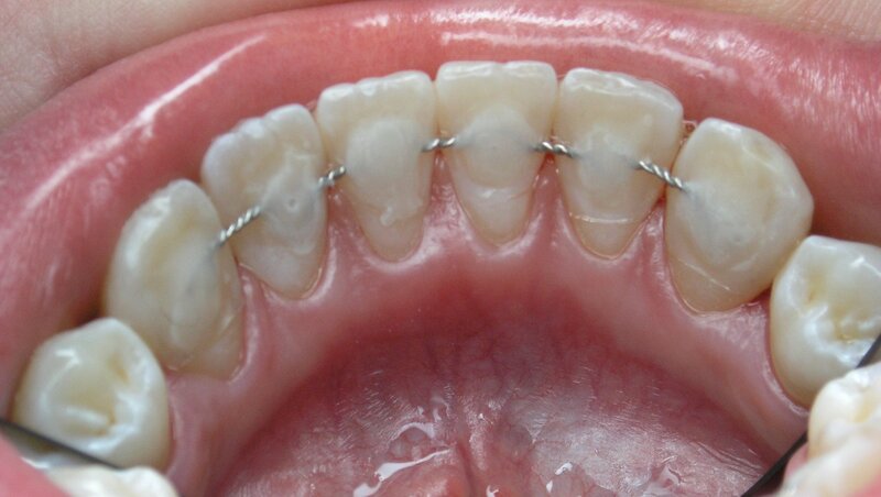 Шинування зубів: що це, навіщо потрібно, види та способи шинування зубів