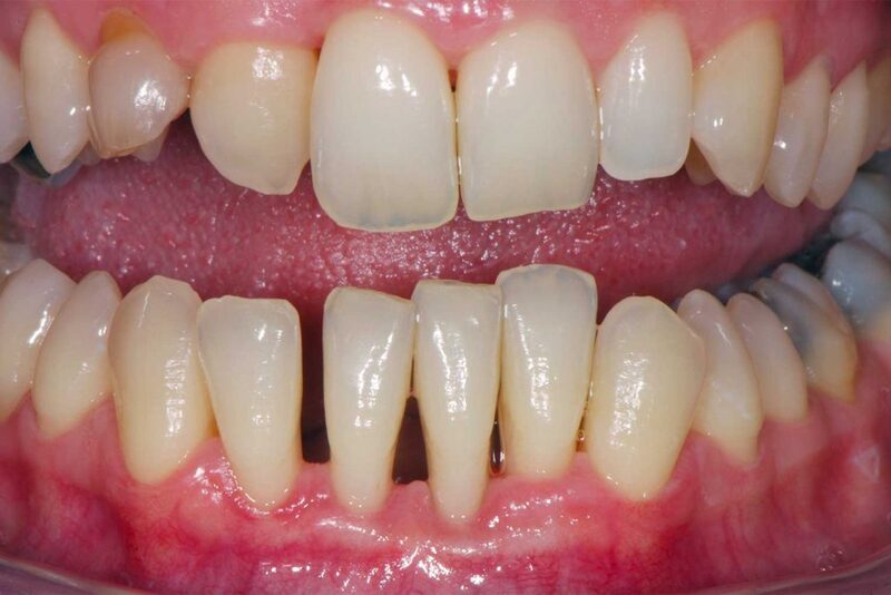 Шинування зубів: що це, навіщо потрібно, види та способи шинування зубів