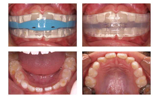 Трейнери для зубів: що це таке, принцип роботи та види трейнерів