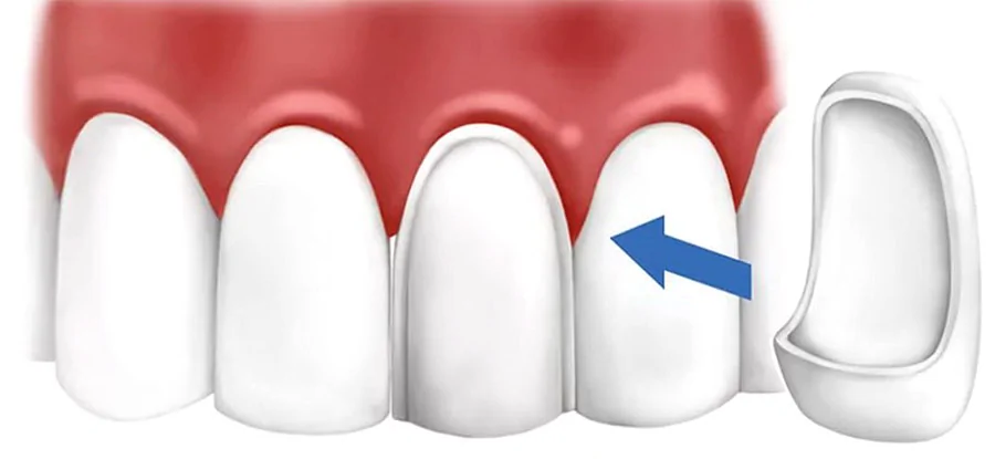 Незнімні зубні протези: види, переваги та недоліки незнімного протезування