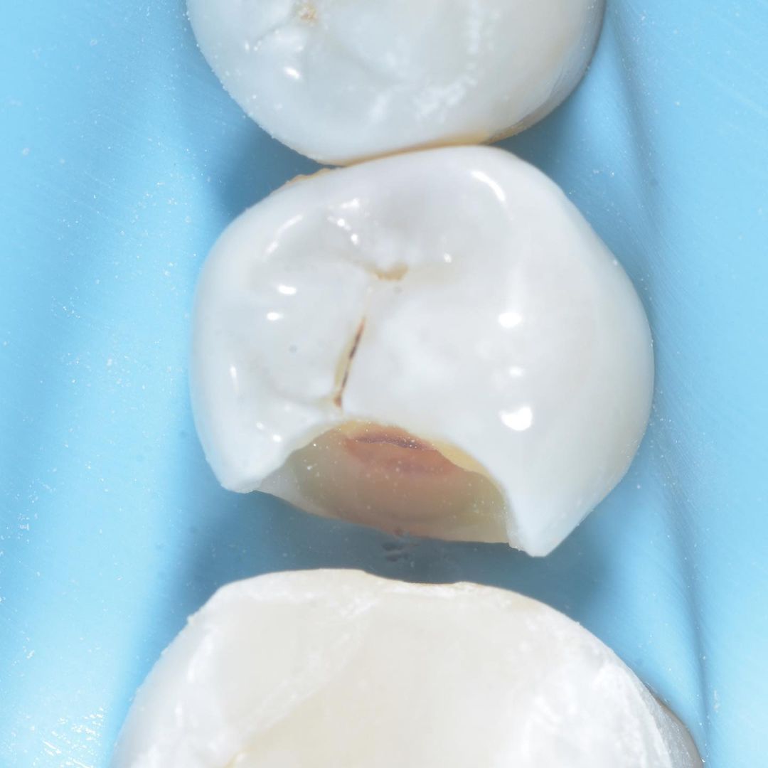 Після препарування, під ізоляцією зуба системою кофердам, було встановлено матрицю для відновлення бокової стінки зуба, та пошаровано внесено композитний матеріал з подальною полімеризацією, та моделювання анатомії зуба.