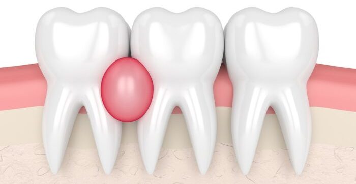 Гранульома зуба: видаляти чи лікувати