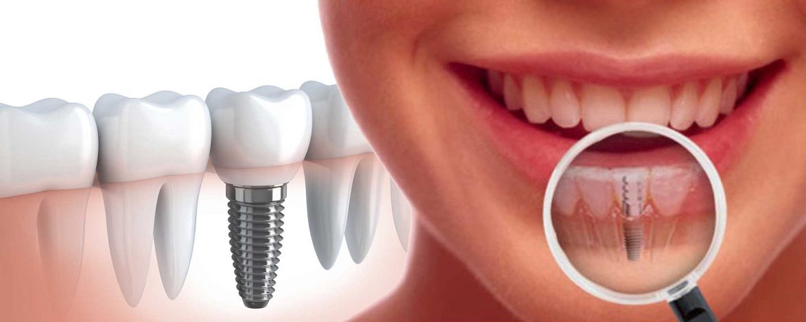 Імплантація зубів: процес, переваги та профілактика ускладнень