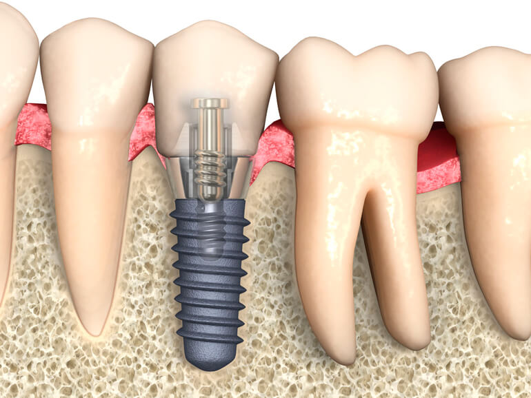 Що таке імплантація зубів