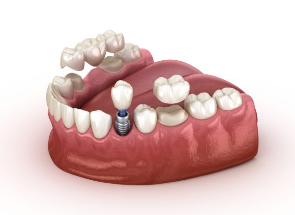 Імплант або зубний міст