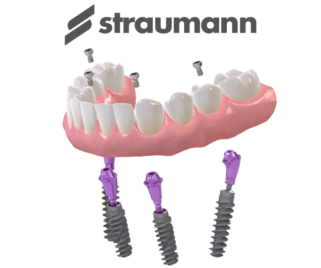 переваги та особливості імплантів Straumann