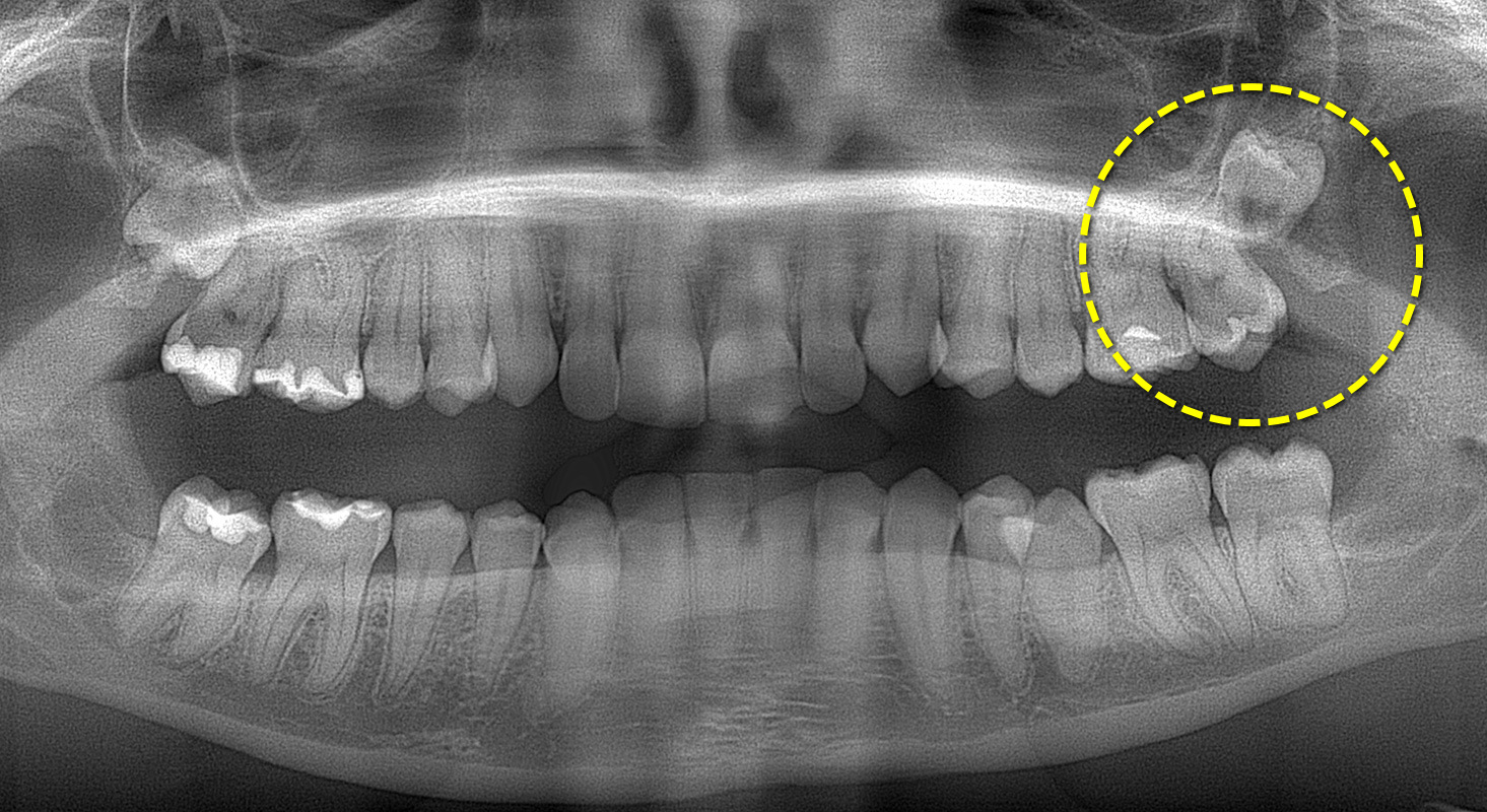 Зуб мудрості: як видаляють та чи потрібно видаляти - Ukrainian Dentist Club  – Стоматологія