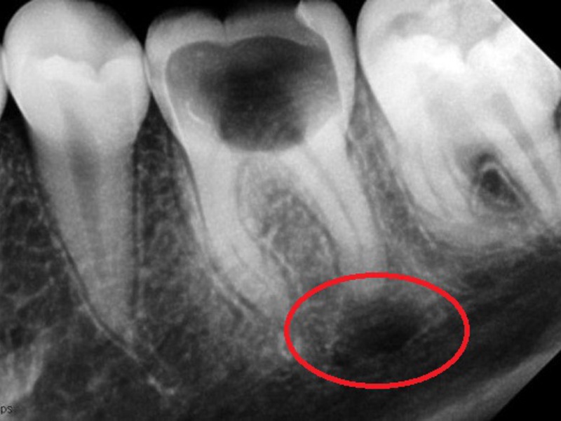 Діагностування гранульоми зуба