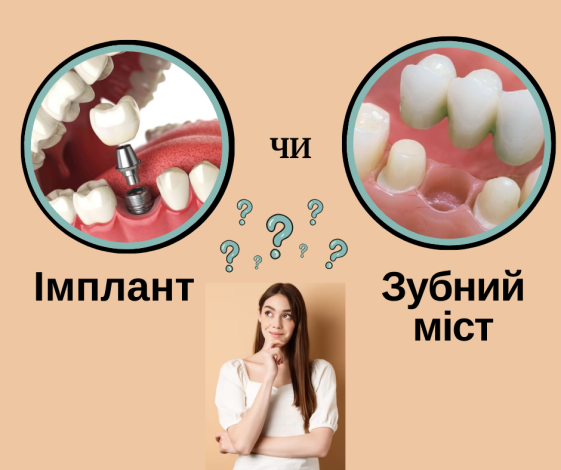 Імплант або зубний міст