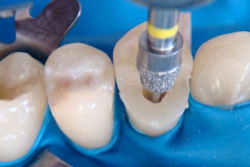 Переваги та недоліки нарощування зуба на штифті порівняно з іншими методами реставрації зубів
