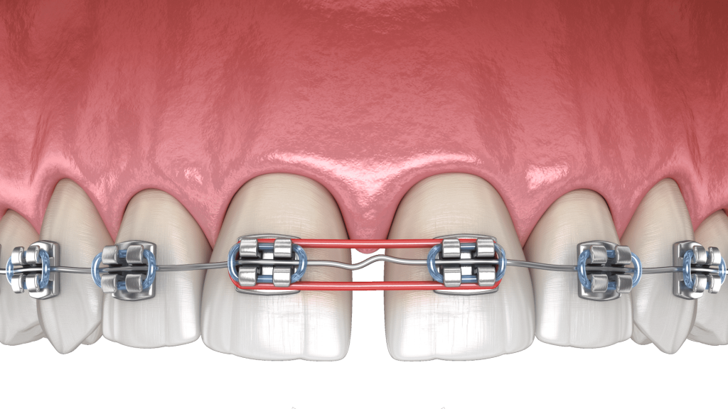 Щілина між зубами: методи корекції діастеми в новітній стоматології