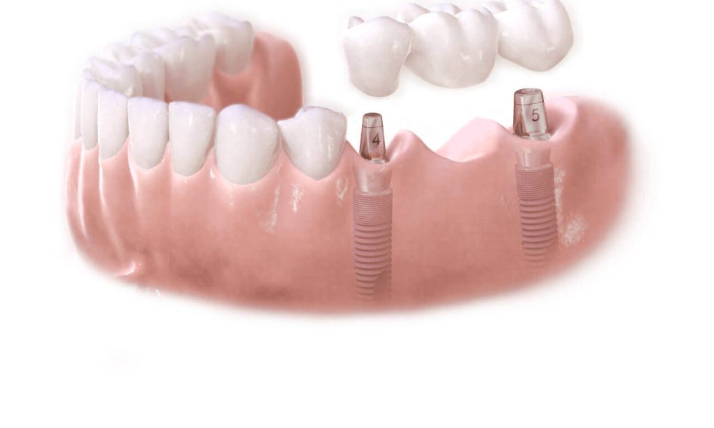 Що таке протезування зубів: різноманіття методів реставрації зубного ряду