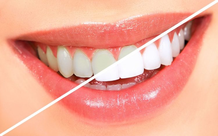 Відбілювання зубів «до» і «після»: підготовчі етапи та догляд за новою посмішкою