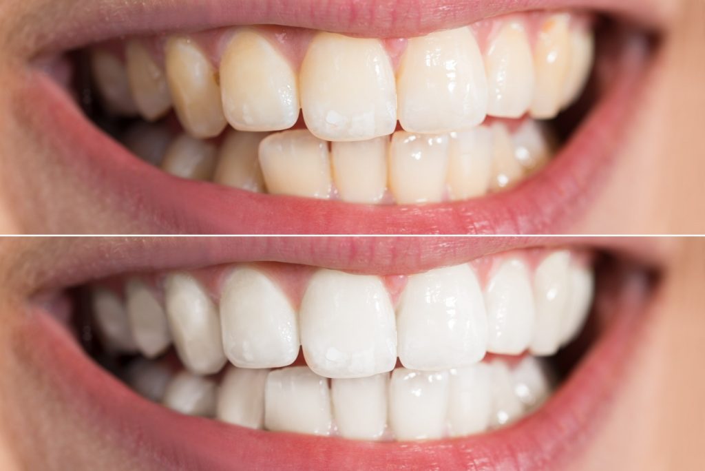 Відбілювання зубів «до» і «після»: підготовчі етапи та догляд за новою посмішкою