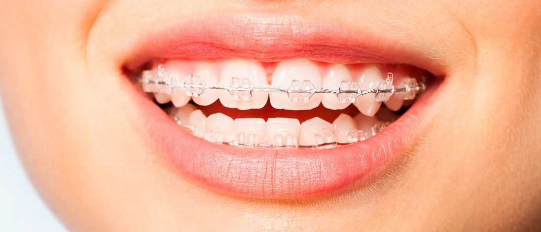 Керамічні брекети: ефективне вирівнювання зубів