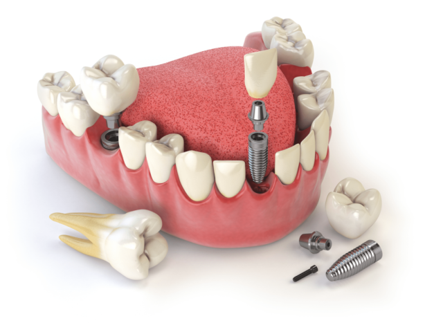 Клініка UDC – надійна допомога в галузі ортопедичної стоматології
