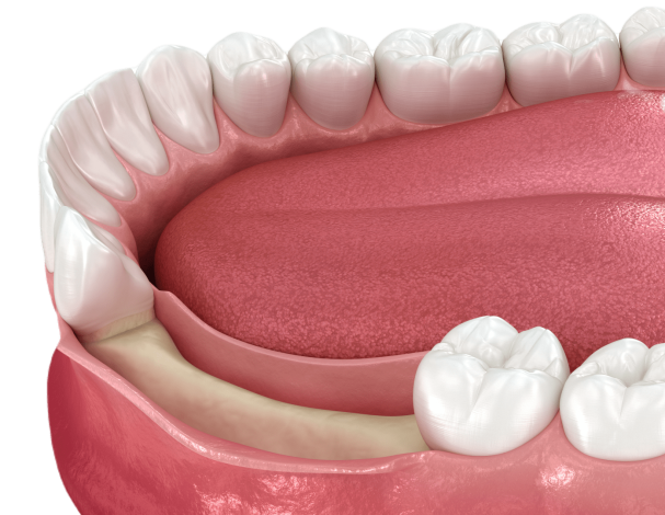 Нарощування кісткової тканини в стоматології