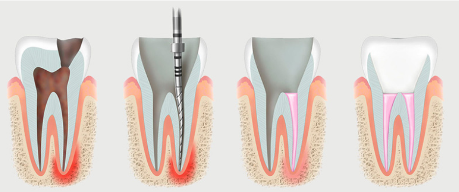 Ендодонтія: сучасні методи лікування кореневих каналів