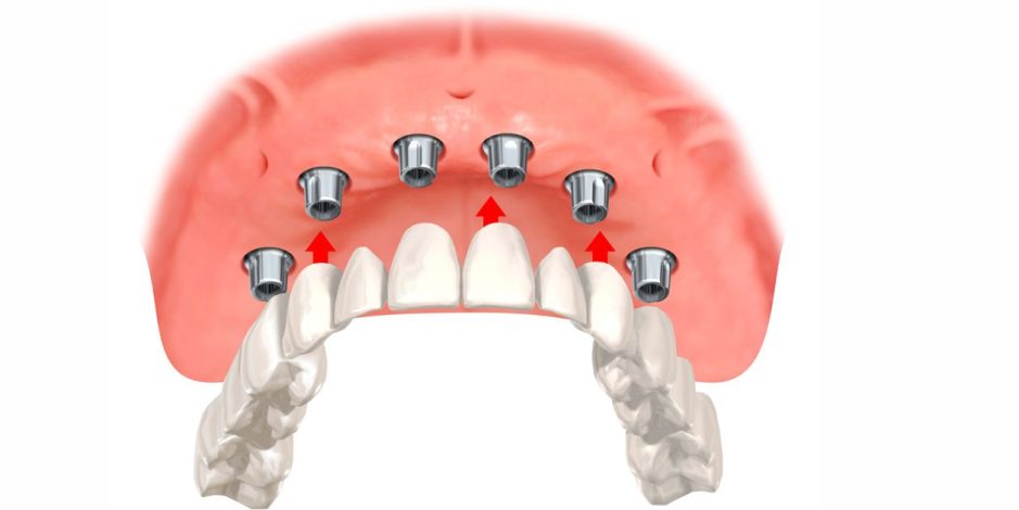 Чим All-on-6 відрізняється від класичної імплантації
