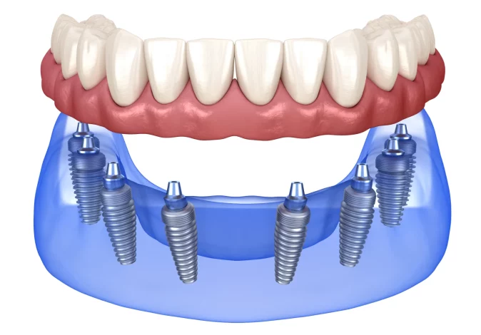 Показання та етапи імплантації зубів All-on-6