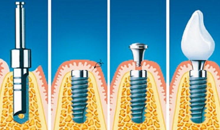 Як ставлять імплант зуба: особливості процесу встановлення та реабілітації