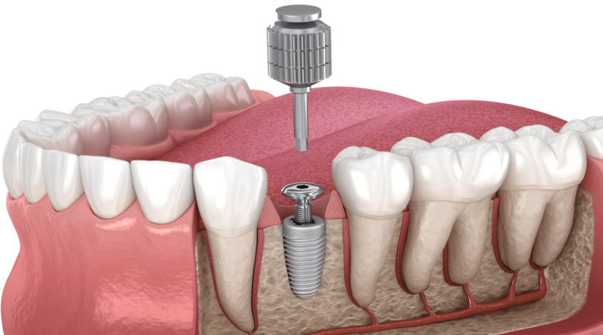 Як ставлять імплант зуба: особливості процесу встановлення та реабілітації